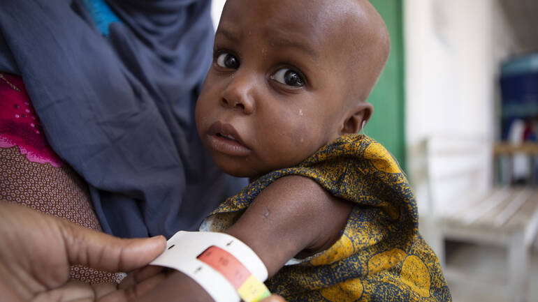 Die kleine Ruweydha aus Somalia ist akut mangelernährt, zeigt das MUAC-Band um ihren Arm.
