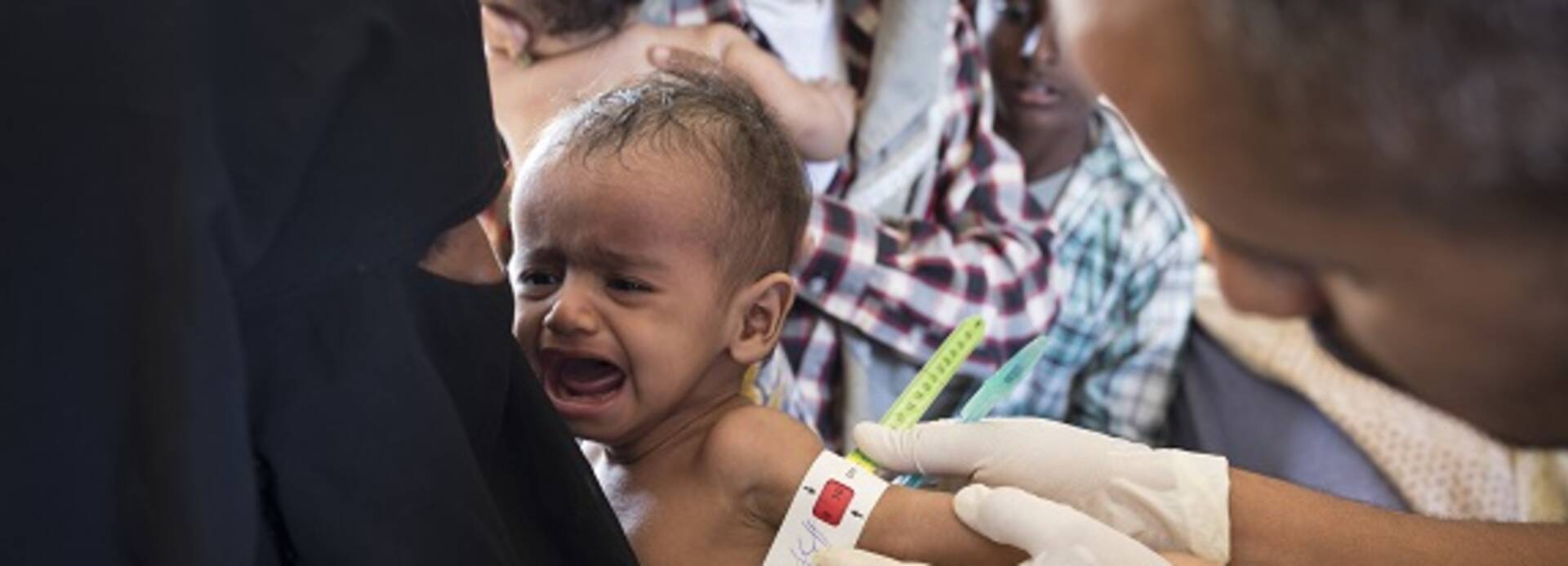 Mangelernährtes Kind im Jemen wird mit dem MUAC Band vermessen