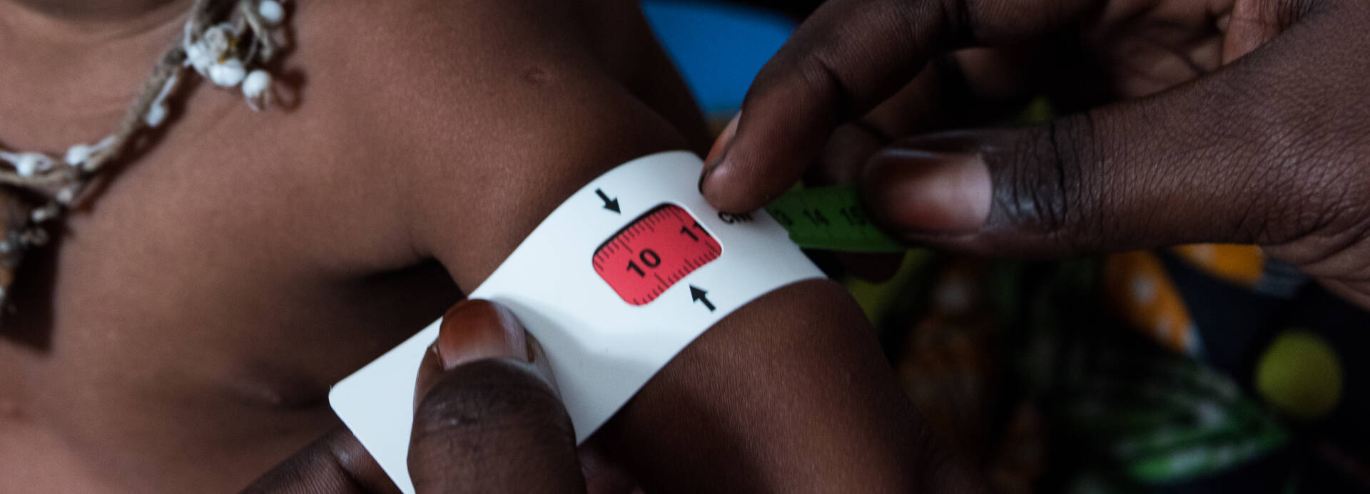 Arm eines Kindes wird mit einem MUAC-Band vermessen und zeigt Mangelernährung.