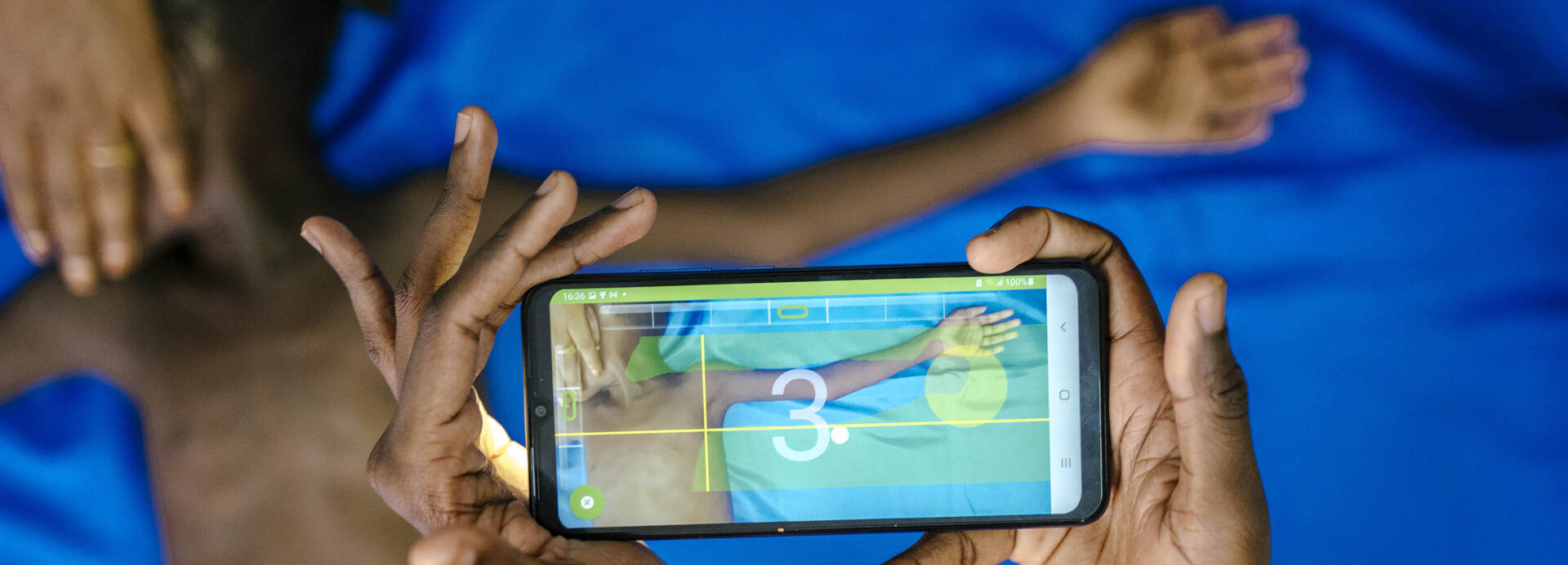 Untersuchung auf Mangelernährung mit der SAM-Foto-App Ein Kind wird mithilfe der SAM-Foto-App auf Mangelernährung untersucht.