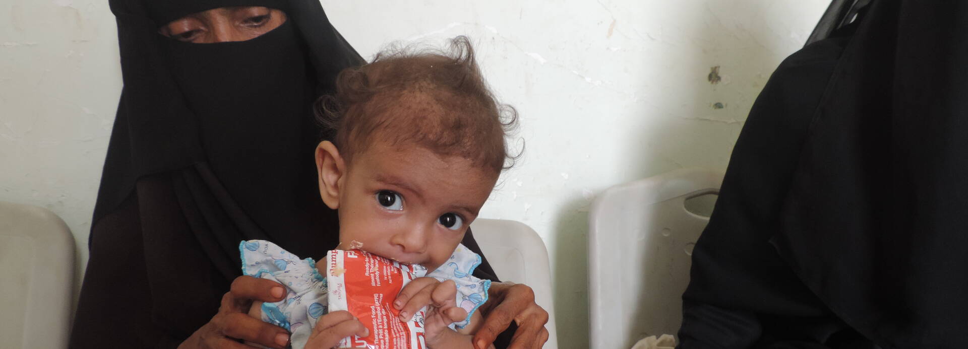 Aktut mangelernährtes Kind im Jemen mit lebensrettender Aufbaunahrung