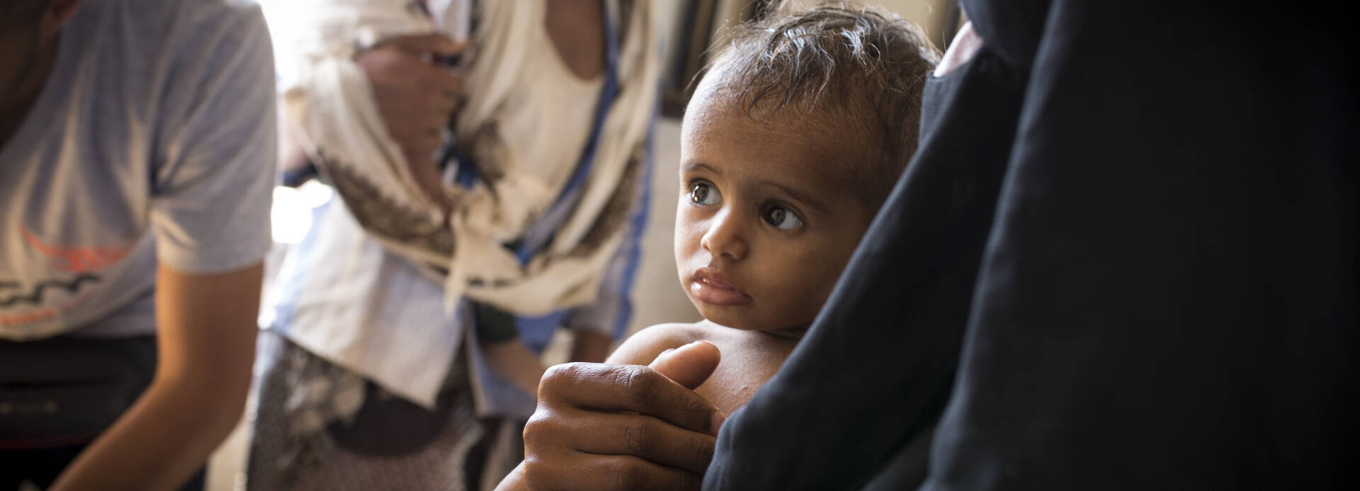 Mangelernährtes Kind auf Krankenstation im Jemen