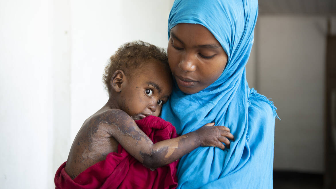 Mangelernährte Halima vor ihrer Behandlung Mangelernährte Halima vor ihrer Behandlung