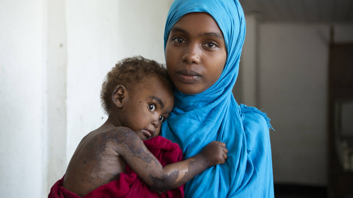 Mutter und mangelernährtes Kind aus Somalia