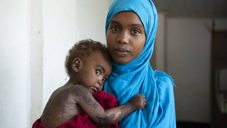 Mangelernährte Halima mit ihrer Mutter Fatuma