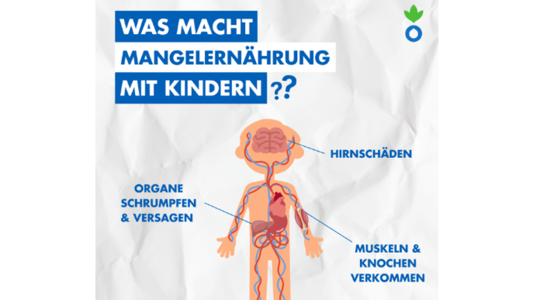 Was macht Mangelernährung mit Kindern? Hirnschäden, Organe schrumpfen, Muskeln & Knochen verkommen