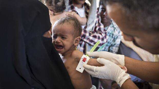 Mangelernährtes Kind im Jemen wird mit dem MUAC Band vermessen