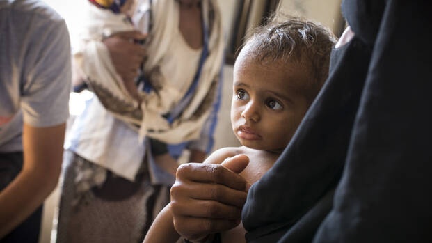Mangelernährtes Kind auf Krankenstation im Jemen