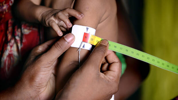 Das Muac-Band um einen Kinderarm zeigt eine akute Mangelernährung an.