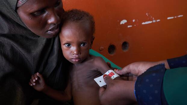 Ali im Arm seiner Mutter, das MUAC-Band an seinem Arm zeigt eine akute Mangelernährung an.