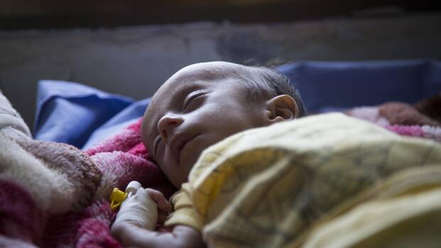 Ein schwer akut mangelernährtes Kind im Jemen mit einer Kanüle am Handgelenk